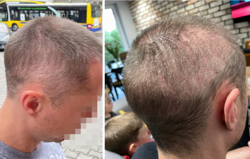 5 meses após transplante capilar cabelo superexplorado