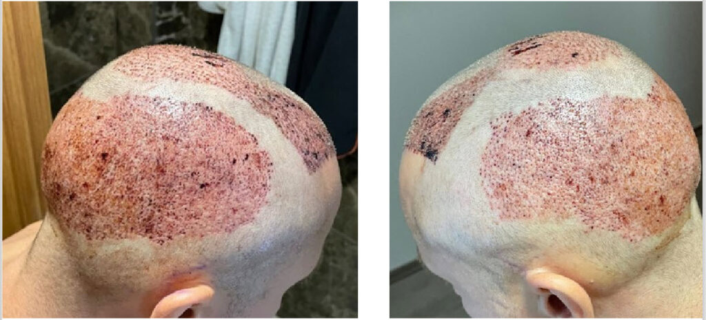 após transplante capilar turquia