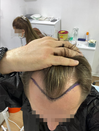 antes do transplante capilar clínica ilegal