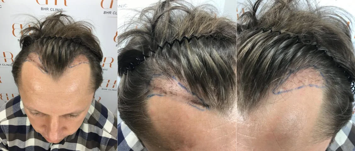 14 meses após o reparo do transplante capilar