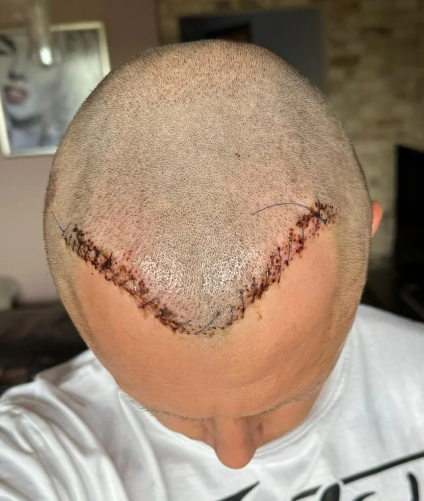 após reparo de transplante capilar